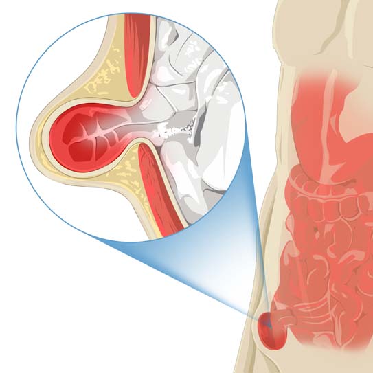 know-more-about-Inguinal Hernia-treatment-in-Hyderabad